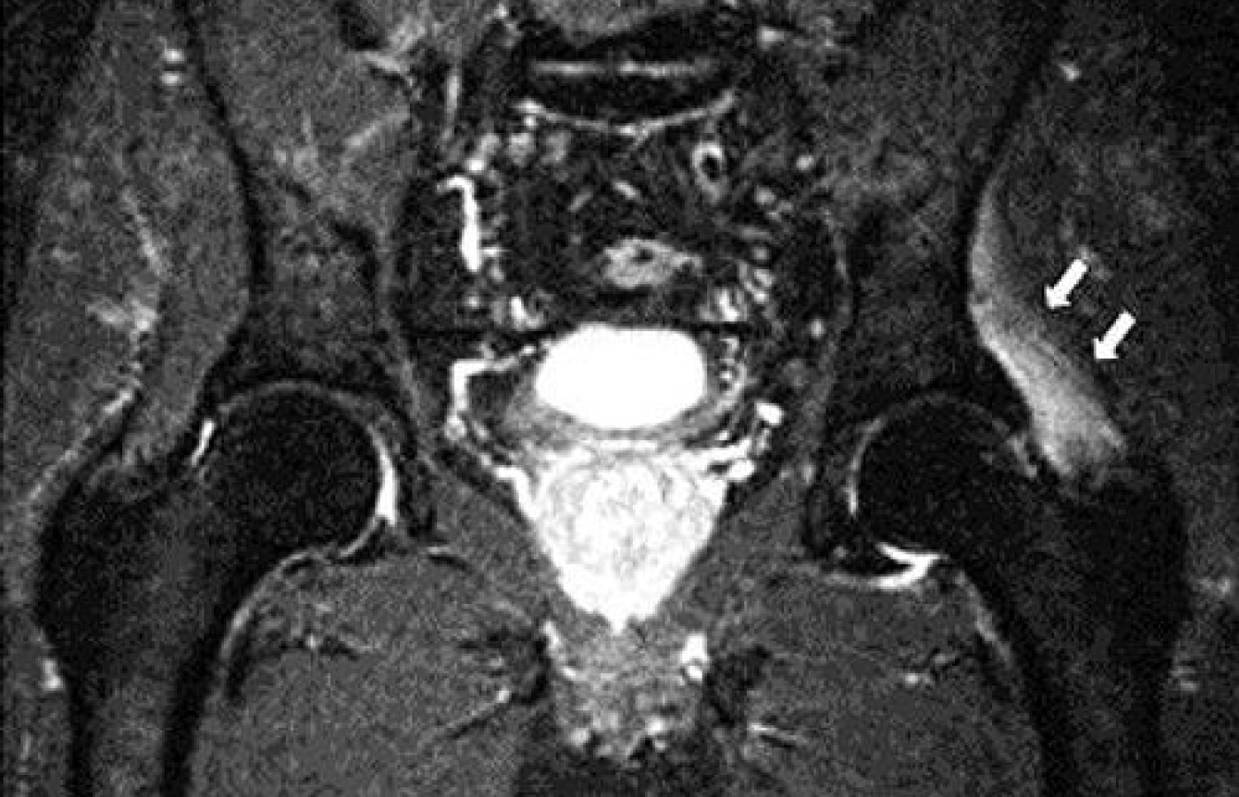 Coronal