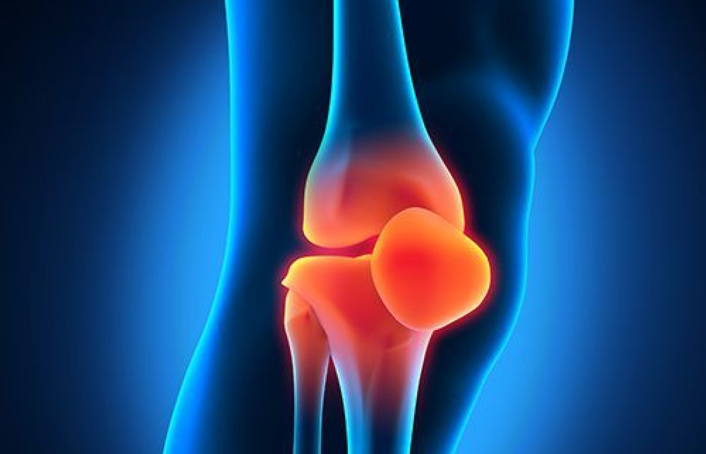 Patellofemoral Arthralgia