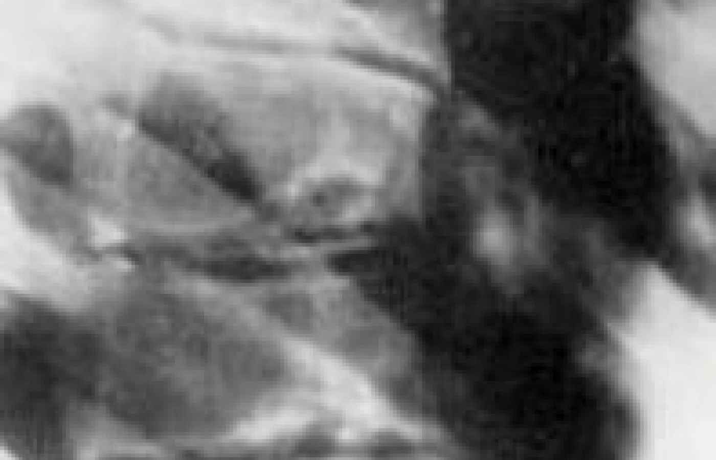 Scheuermann’s Disease: A Poorly Understood Abnormality of the Adolescent Spine